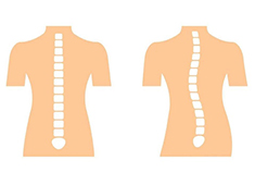 脊柱側(cè)彎的測量方法以及判定標(biāo)準(zhǔn)解讀