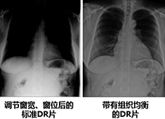 影響醫(yī)用X射線影像設(shè)備成像質(zhì)量的主要指標和因素