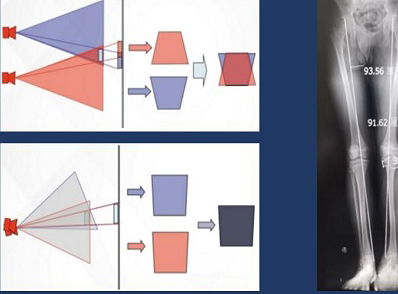拍攝全脊柱X光片 長(zhǎng)骨拼接技術(shù)和一板成像的區(qū)別