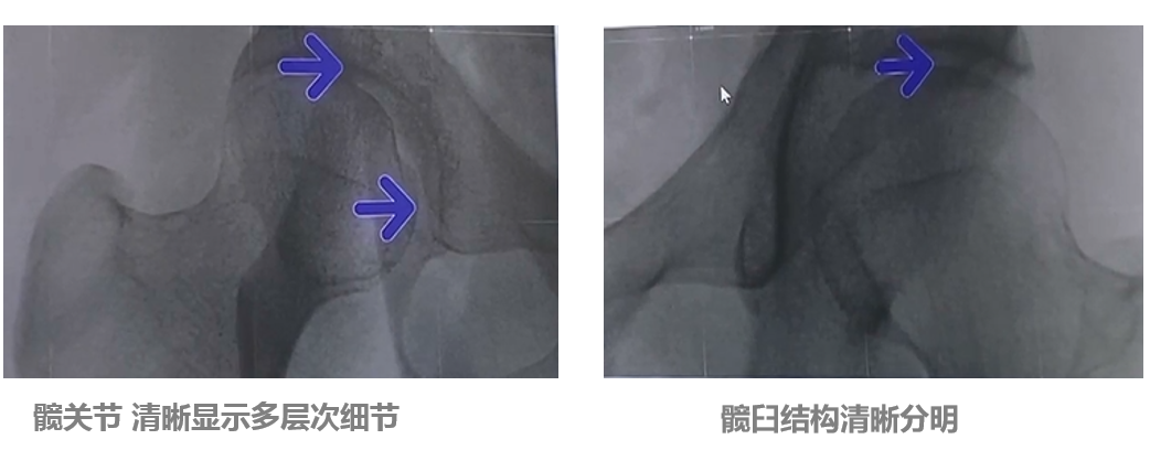 平板小C髖關節成像效果