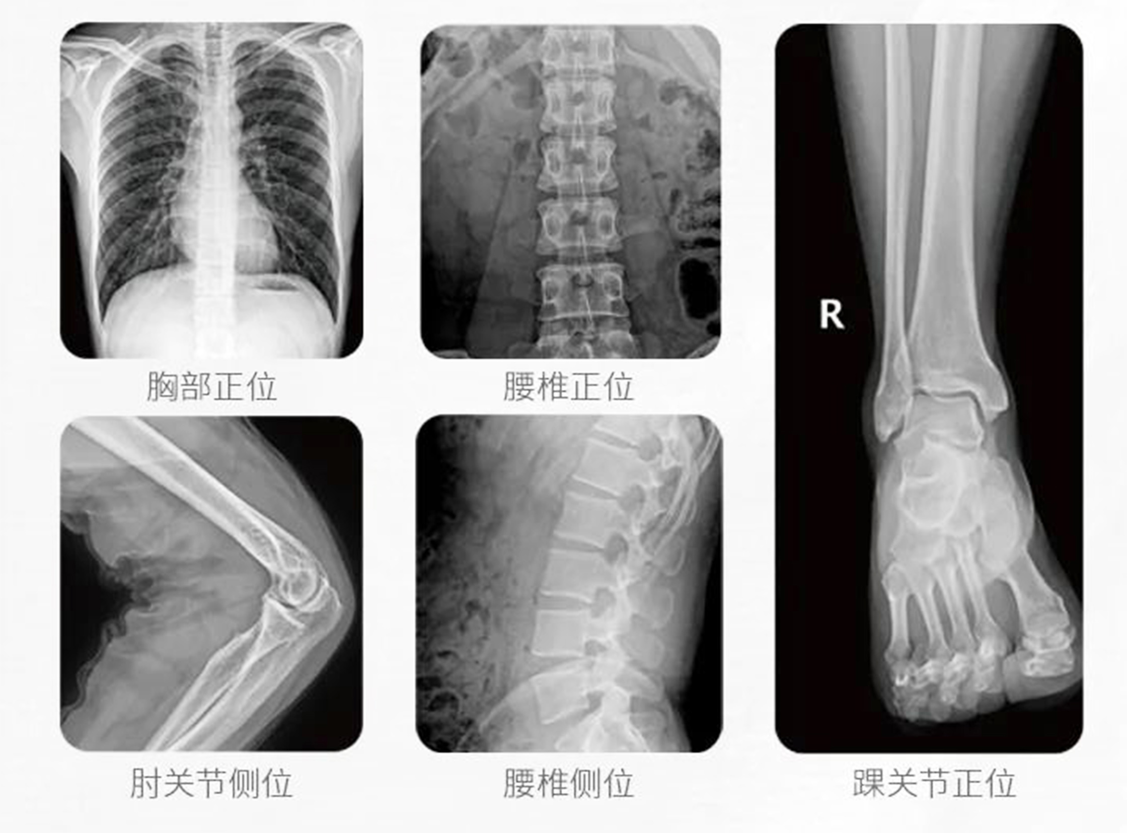 移動(dòng)式DR臨床影像