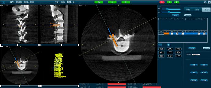 脊柱手術機器人準確定位