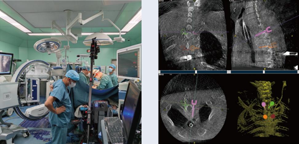 術(shù)中三維C形臂影像在脊柱導(dǎo)航機器人系統(tǒng)中的應(yīng)用
