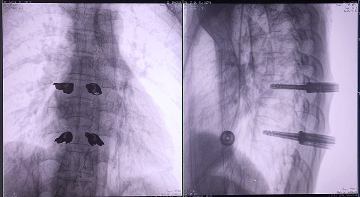 機器人做胸椎置釘手術