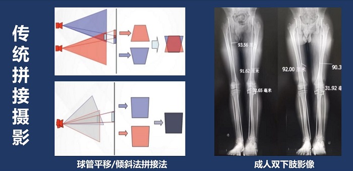 長骨拼接技術拍攝全脊柱X光片